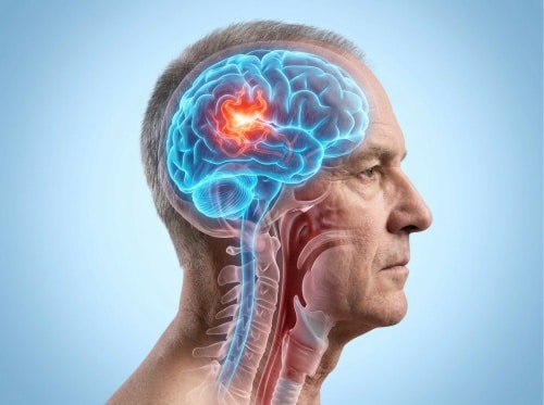 Tratamento de Malformacao arteriovenosa