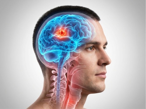 Tratamento de cavernomas