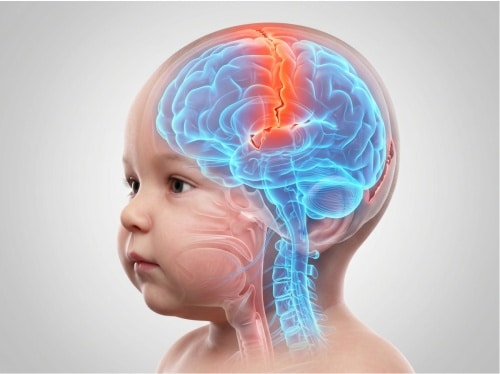 Tratamento de cranioestenose