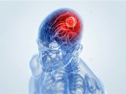 Tratamento de gliomas e glioblastoma