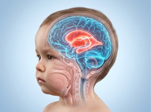 Tratamento de hidrocefalia