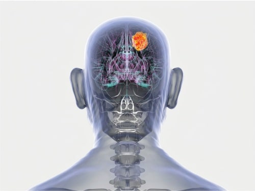 Tratamento de meningioma