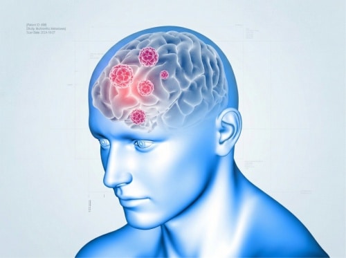 Tratamento de metastases cerebrais​