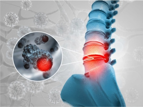 Tratamento de tumores de coluna